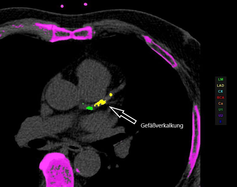CT Herz Calziumscore