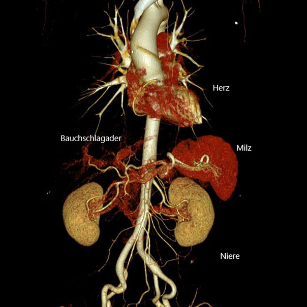 CT bauchraum