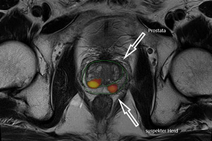 vor Prostata